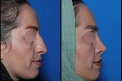 nose-surgery-0400