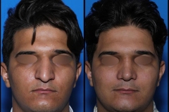 nose-surgery-0401