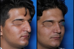 nose-surgery-0402