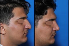 nose-surgery-0403