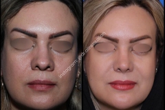 nose-surgery-0404