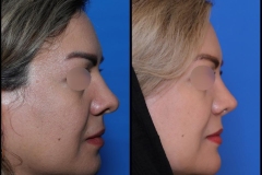nose-surgery-0405