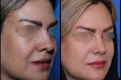 nose-surgery-0406