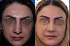 nose-surgery-0407