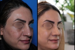 nose-surgery-0408