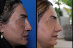 nose-surgery-0409