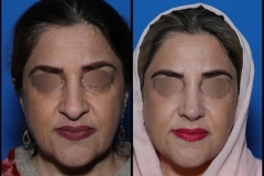 nose-surgery-0410