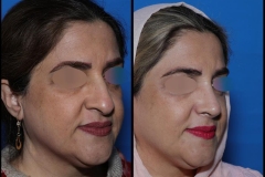 nose-surgery-0411