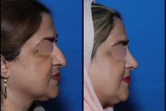 nose-surgery-0412