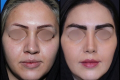 nose-surgery-0413