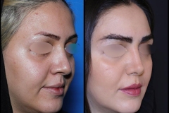 nose-surgery-0414