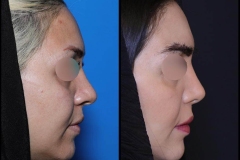 nose-surgery-0415