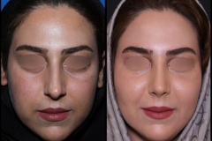 nose-surgery-0416
