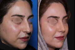 nose-surgery-0417