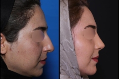 nose-surgery-0418