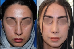 nose-surgery-0419