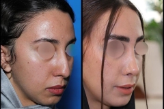 nose-surgery-0420