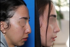 nose-surgery-0421