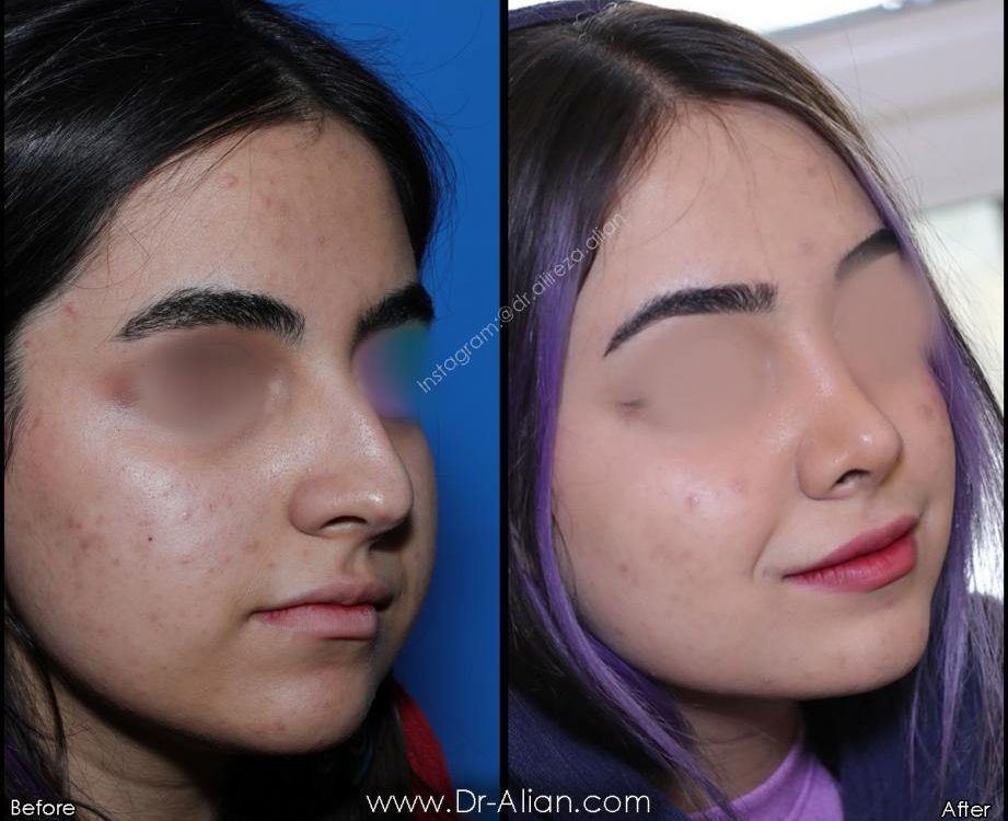 آیا انحراف بینی بعد از عمل برمیگردد؟