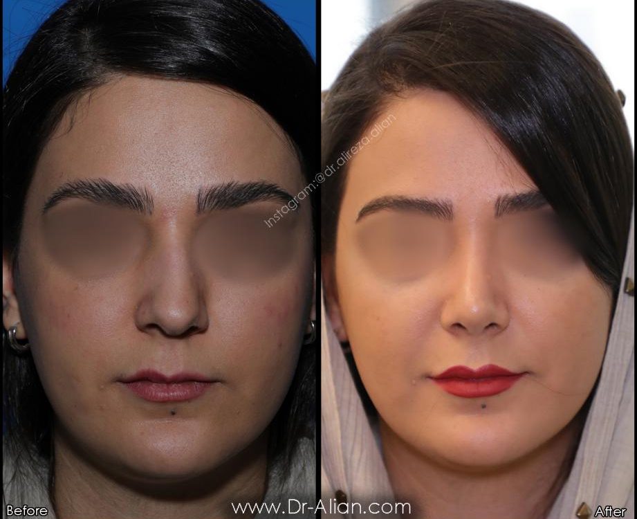 سوالات متداول عمل بینی
