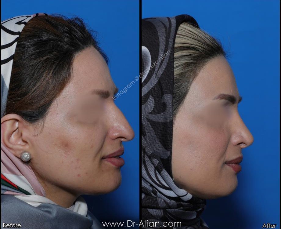 كيف تتم عملية الأنف الكبيرة جدا؟