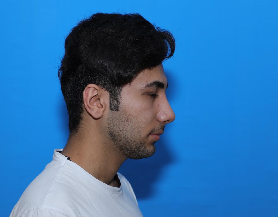 چرا پس از عمل بینی سرفه و عطسه می کنم؟ + نحوه صحیح سرفه کردن