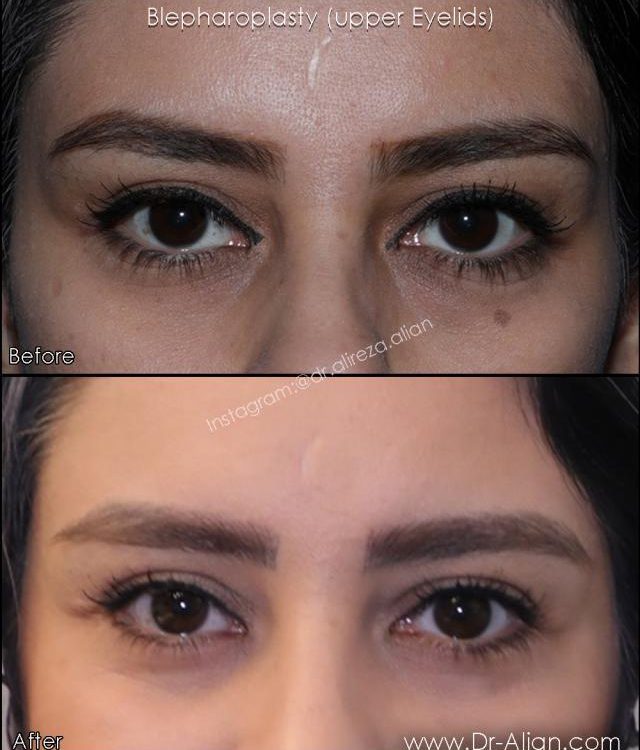 انواع روش های جراحی پلک