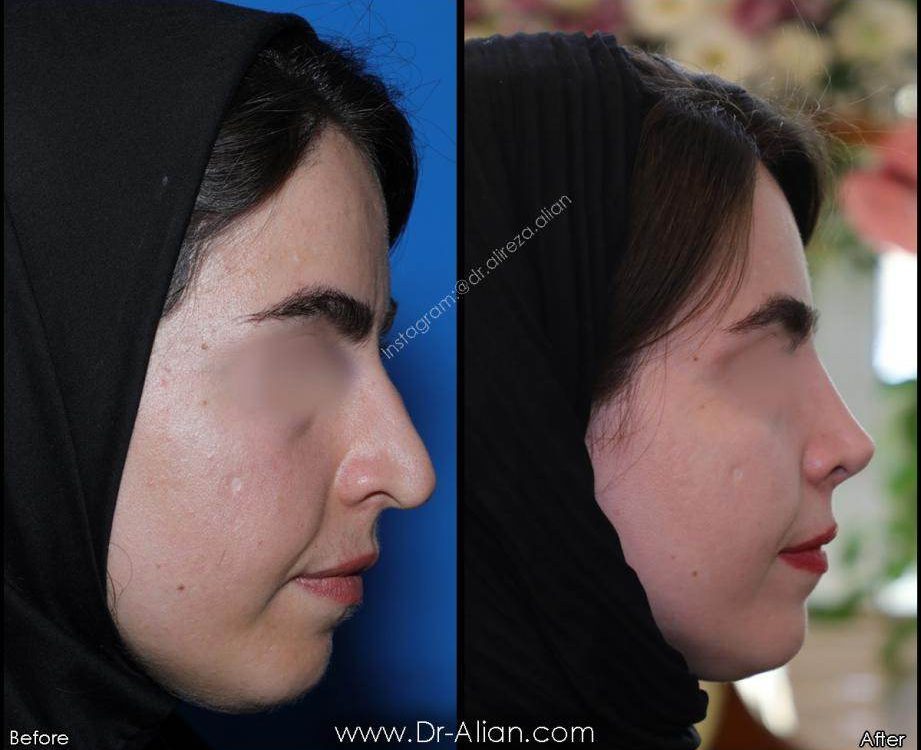 جراحی بینی بعد از سانحه