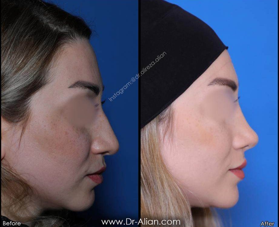 نتیجه گیری تفاوت عمل بینی طبیعی و بینی فانتزی