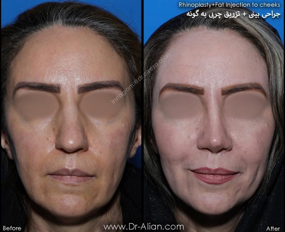 آیا بوکال فت باعث پیری می شود؟