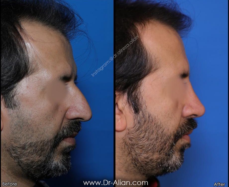 آبریزش بینی