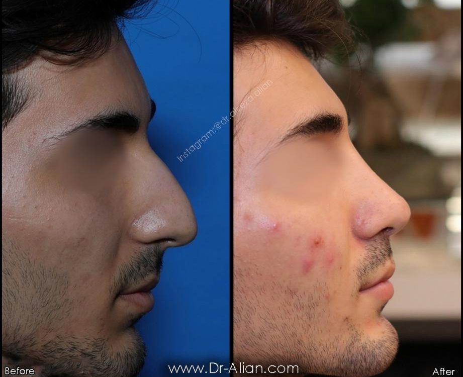 Scar formation after nose surgery