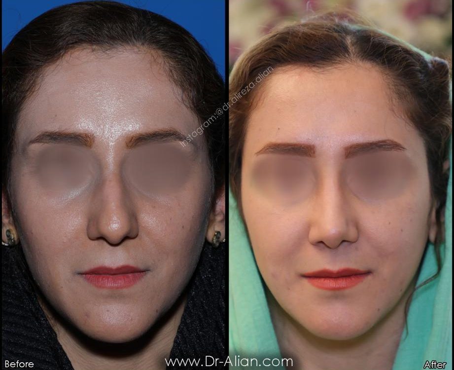 تفاوت رینوپلاستی و سپتوپلاستی چیست؟
