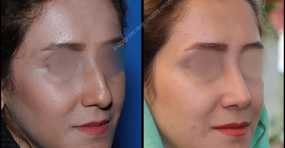 مجموعه مراقبتهای پس از عمل بینی