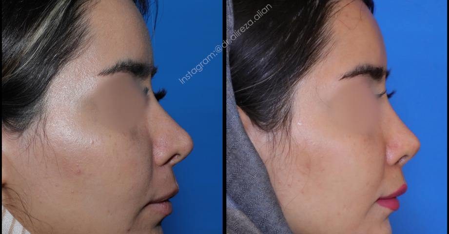 چه زمانی به رینوپلاستی ثانویه نیاز داریم؟