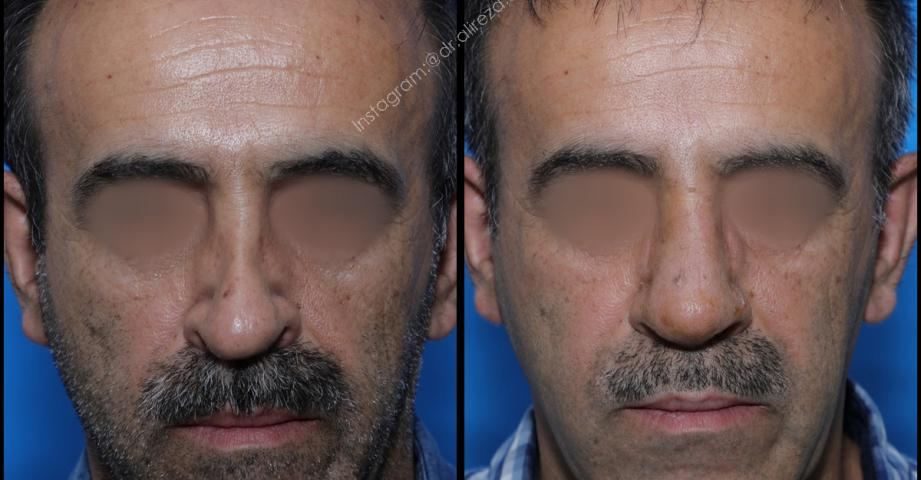 عمل بینی برای افراد بالای 40 سال