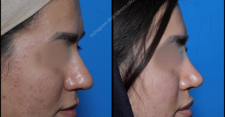 تفاوت عمل بینی طبیعی و فانتزی چیست؟