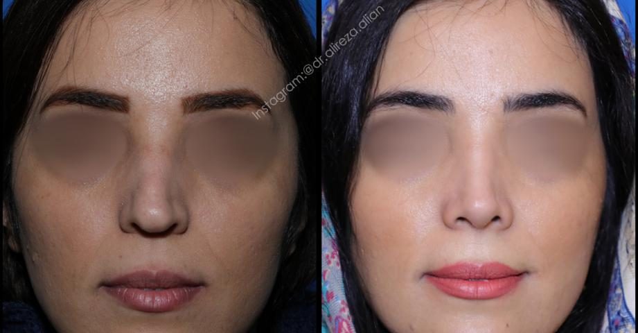 چگونه از عفونت بعد از عمل بینی جلوگیری کنیم