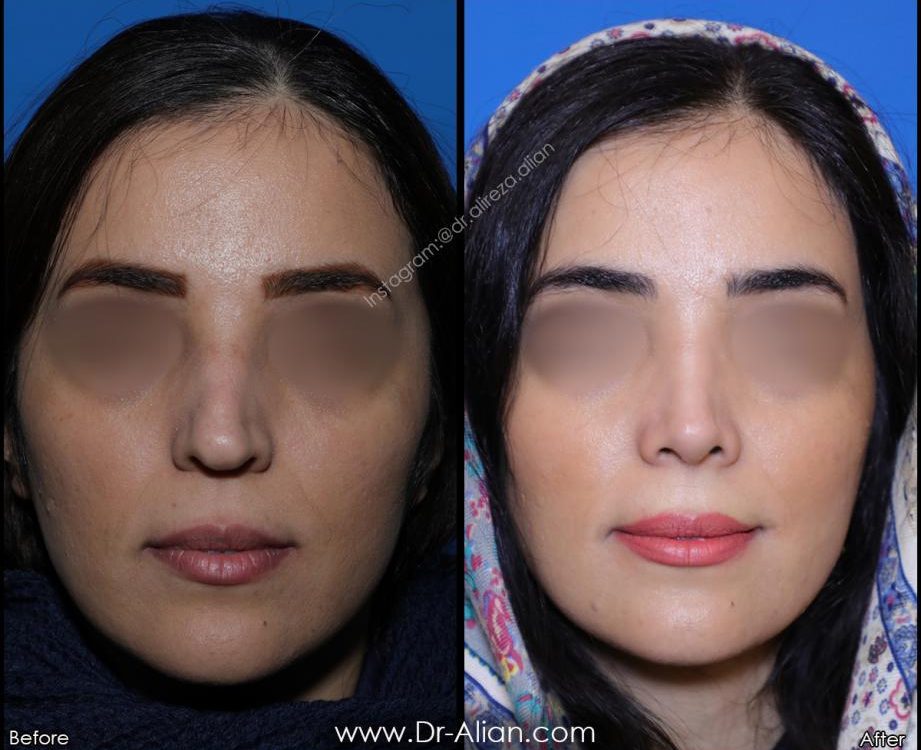 چگونه از عفونت بعد از عمل بینی جلوگیری کنیم