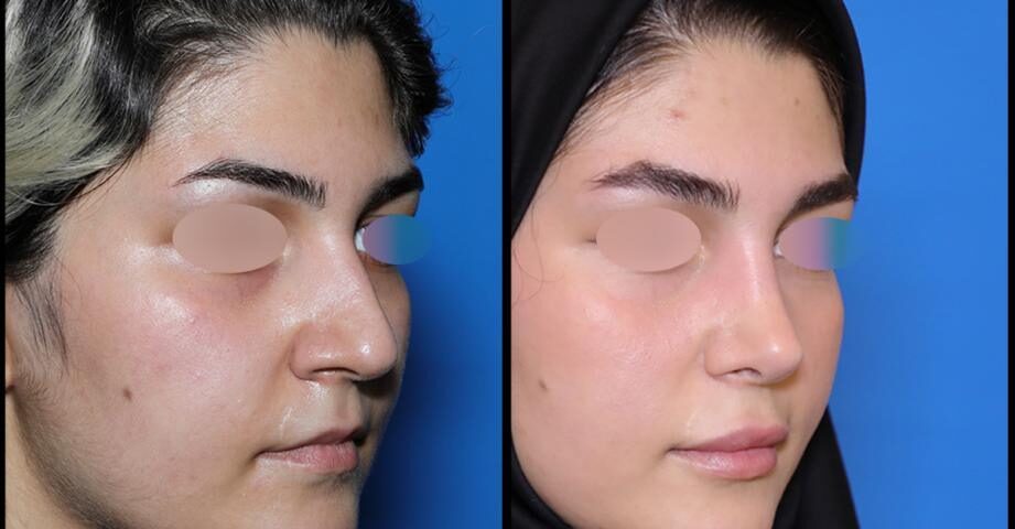 عمل بینی در زمستان