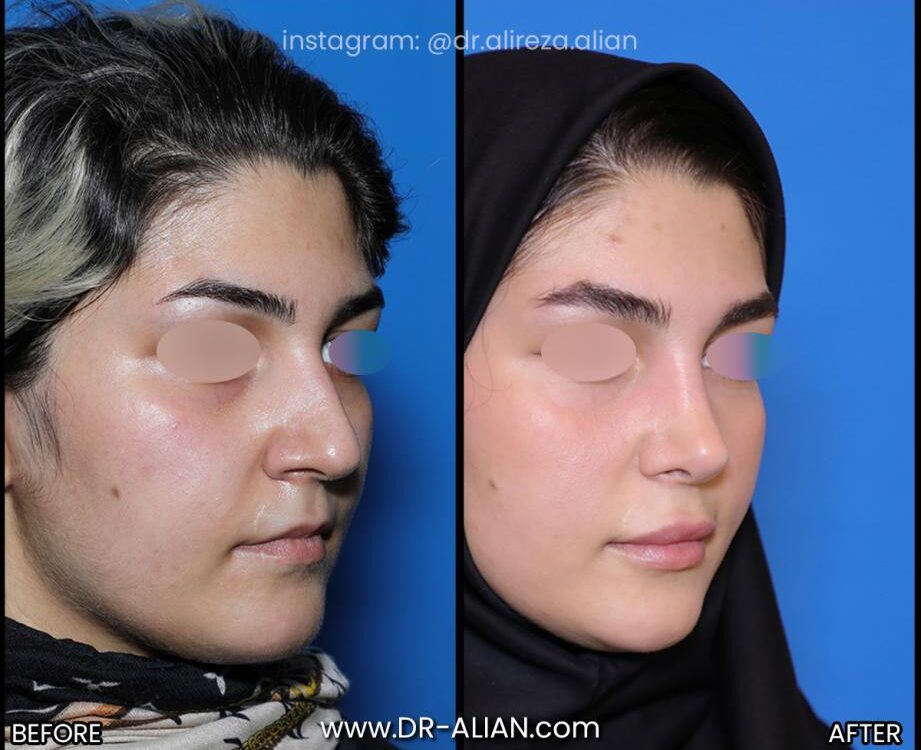 عمل بینی در زمستان