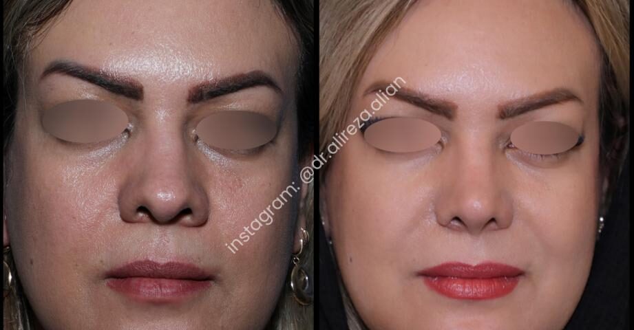 نوک بینی گرد بهتره یا تیز؟