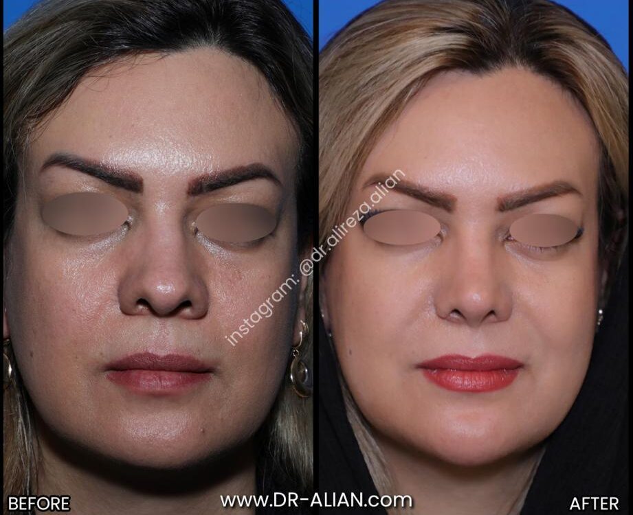 نوک بینی گرد بهتره یا تیز؟