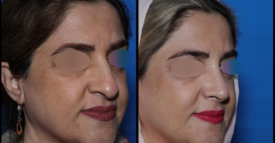 جراحی بینی کج