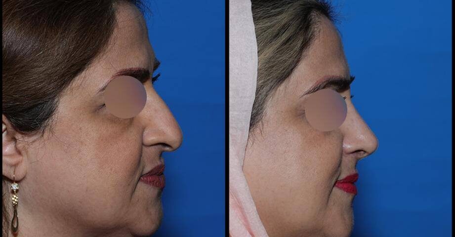 گرفتگی بینی بعد از عمل