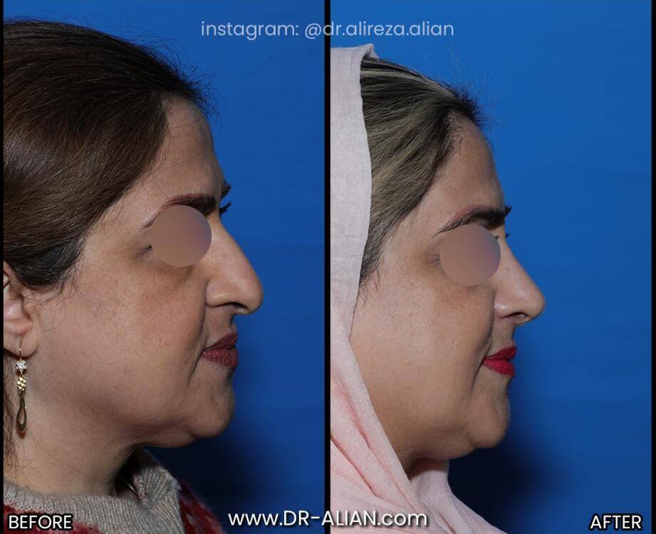 گرفتگی بینی بعد از عمل