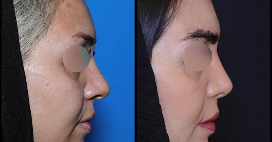 کم خونی و عمل بینی