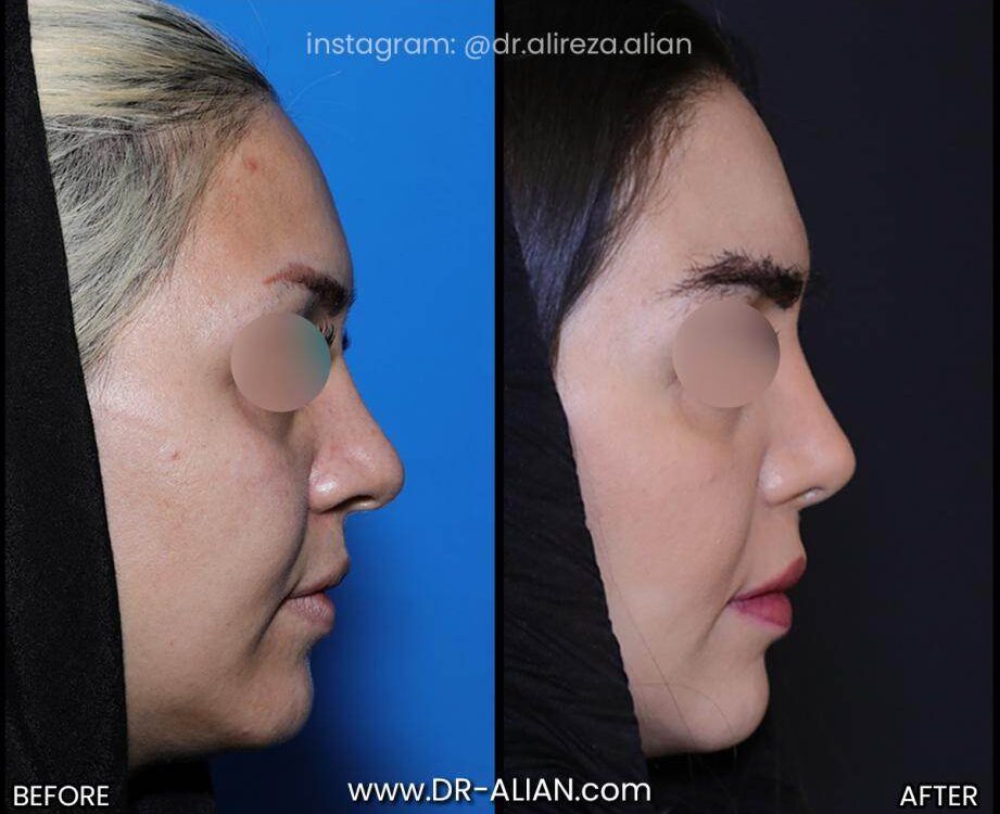 کم خونی و عمل بینی