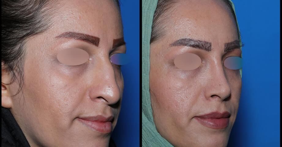 کوچک کردن سوراخ بینی