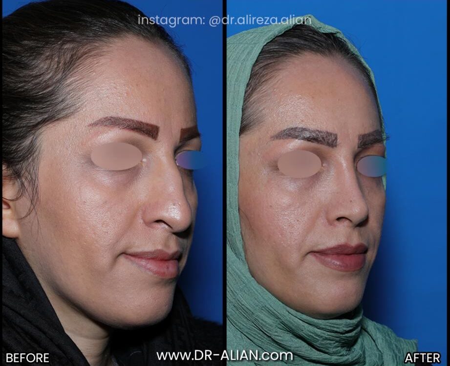 کوچک کردن سوراخ بینی